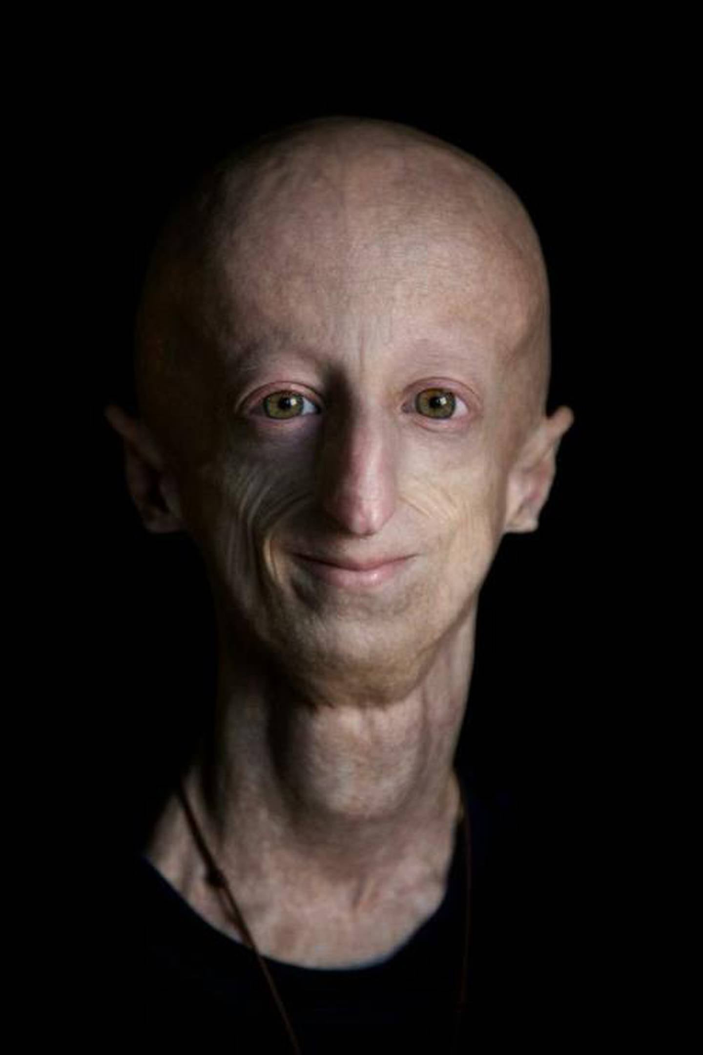 Sammy Basso is a biologist, spokesperson for the Italian Progeria Association Sammy Basso APS and global ambassador for the Progeria Research Foundation.
